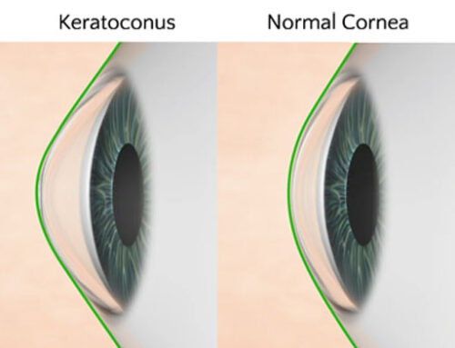 أفضل دكتور لعلاج القرنية المخروطية