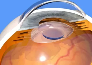 عملية المياه البيضاء في العين