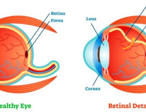 أسباب تمزق شبكية العين وطرق علاجها